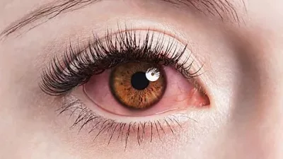 Acute Viral Conjuntivitis